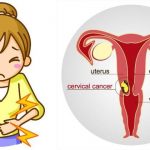 cervical cancer