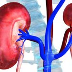 kidney disease