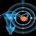 Ovarian Cancer Can Now Be Diagnosed Easily And May Prevent Unnecessary Surgeries