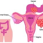 Ovarian Cancer Can Now Be Diagnosed Easily And May Prevent Unnecessary Surgeries